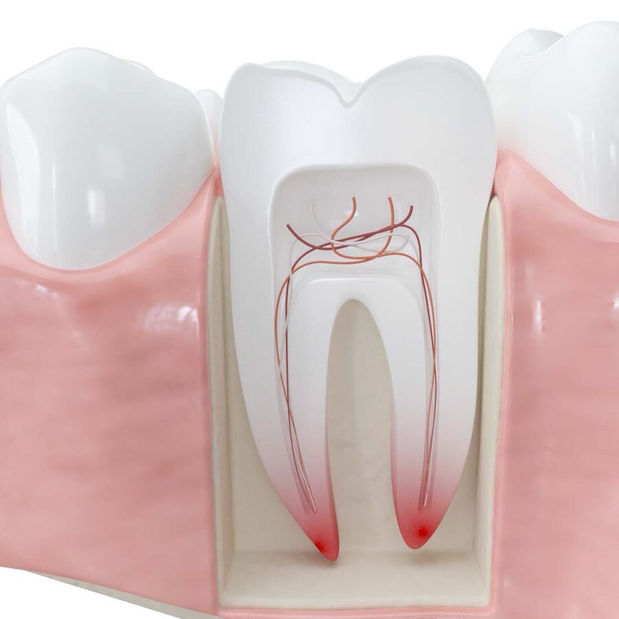 Endodontie : Entzündung des Zahnmarks Entzündung des Zahnmarks